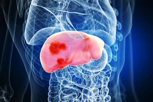 Liver Disease/Hepatitis