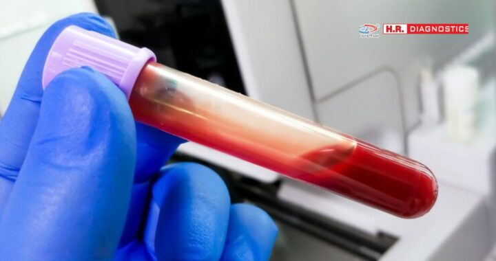 CBC Blood Test: Importance, Process, and Results | H.R. Diagnostic