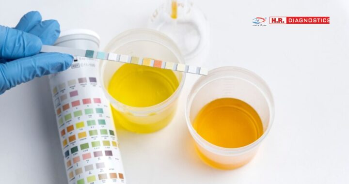 Urinalysis: Essential Test for Detecting Health Conditions