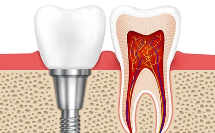 Dental Implants